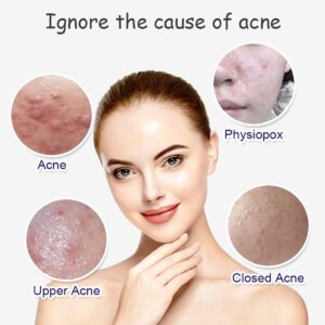 Aichun Beauty Anti - Acne Whitening Facial Serum Aloe Vera Extract Salicylic Acid Repairs Damaged Skin | 30ml - Image 4