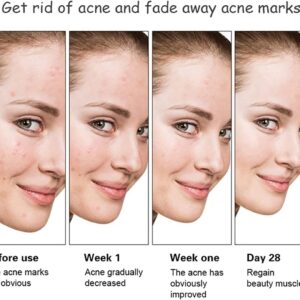 Aichun Beauty Anti - Acne Whitening Facial Serum Aloe Vera Extract Salicylic Acid Repairs Damaged Skin | 30ml - Image 1