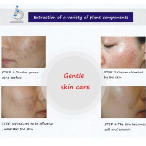 BIOAQUA Anti Acne Cream Acne Scar Removal Cream | Best Quality Scar Removal Cream 30g( Original ) - Image 3