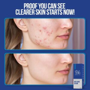 Wiki Special Anti Acne Serum | Clears Acne, Soothes Skin & Fights Blemishes (30ml) - Image 3